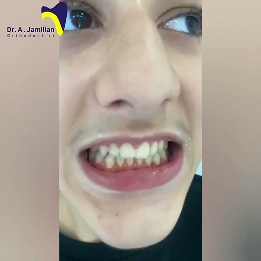 How to Debond Brackets Without Damaging Enamel #dentist #debonding #dentaltreatment #orthodontics