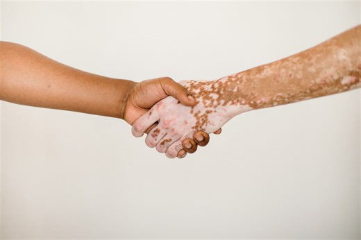 Psoriasis en uñas: tratamientos | Somos Pacientes