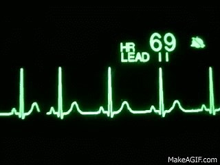 Normal Sinus Rhythm on Make a GIF