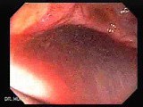 Massive Rectal Bleeding (3 of 11) • Video • MEDtube.net