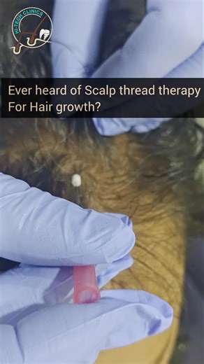 ever heard of Scalp thread therapy for hair loss? check out the video