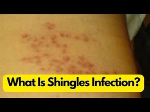 What Is Shingles Infection? Causes, Symptoms & Treatment Explained