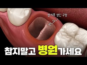 사랑니 발치 후 통증이 지속된다면? 드라이소켓일 가능성이 있습니다!! [알아두면 쓸모있는 치과 잡학사전]