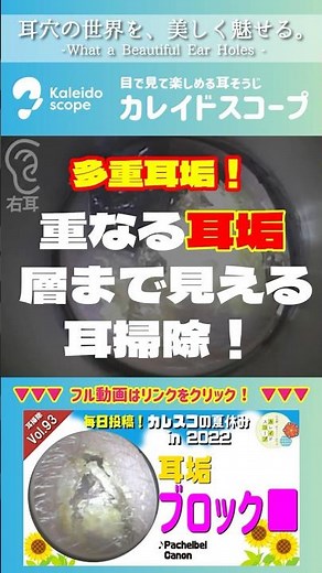 【多重耳垢】重なる耳垢 層まで見える耳掃除