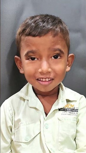 “Blepharophimosis Surgery in a 5-Year-Old | CU Plasty with Frontalis Sling | Dr. Rohit Rao”
