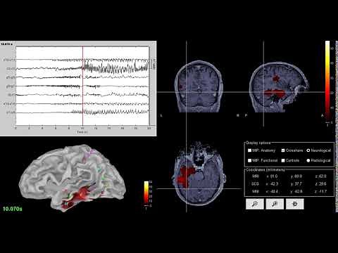 Brainstorm SEEG tutorial: epileptogenicity maps