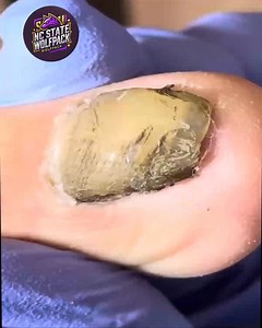 Simple Steps to Support Toenail Pressure Relief For All-Day Relief #ToenailRoutine #SimpleNailCare #NailCareTips #HealthyNails | NC State Wolfpack on TheWolfpacker.com