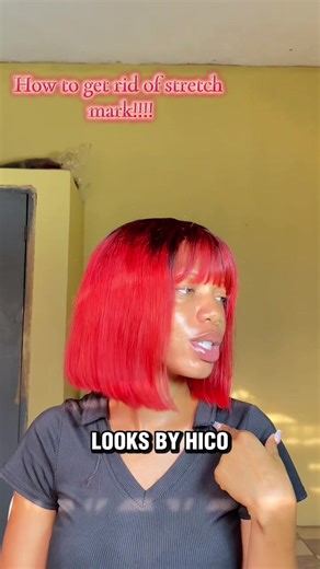 Effective Tips to Remove Stretch Marks Easily