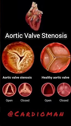 Normal Aortic valve Vs Aortic valve stenosis 👈