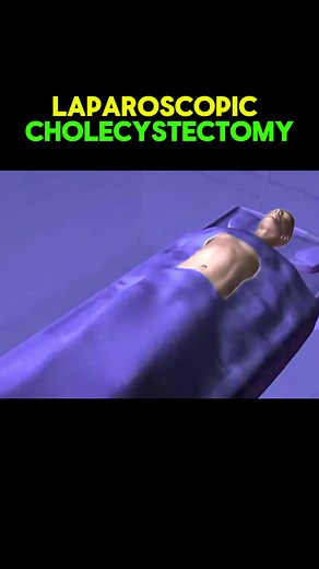 Laparoscopic Cholecystectomy procedure 3d animation video #laparoscopicsurgery #endometriosis #surgery #animation #endometriose #laparoscopic #medical #learnwithtiktok