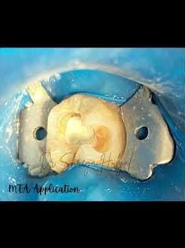 Direct pulp capping with MTA