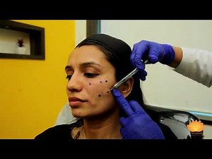 MD codes for MidFace Lift with Voluma Filler