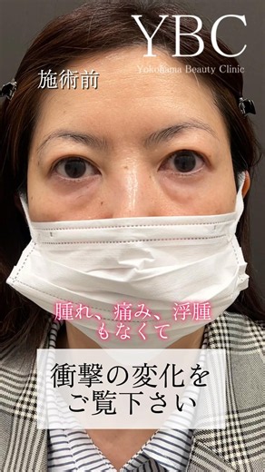 See the Shocking Transformation #UnderEyeBagRemoval #UnderEyeDarkCircles #UnderEyeSaggingRemoval ...