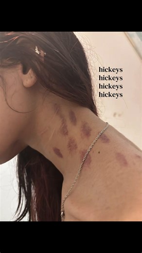 Understanding Hickeys: What They Are and How to Deal