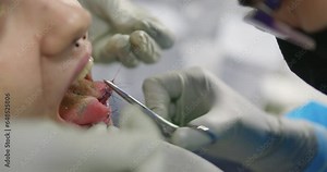 tongue splitting. cutting the tongue, one type of modification of the human body. surgery concept.