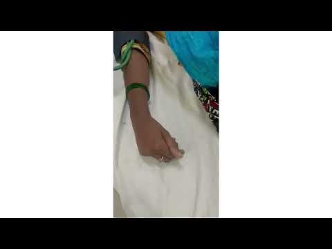 TROUSSEAU'S SIGN - Carpopedal spasm seen in Hypocalcemia