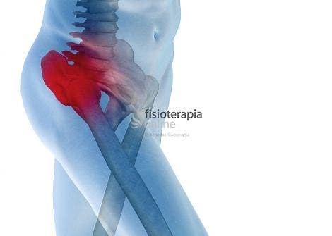 Artrosis de cadera o coxartrosis. Síntomas, Diagnóstico y tratamiento de fisioterapia.