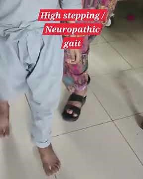 Neuropathic or high stepping gait- Gait examination in neurology