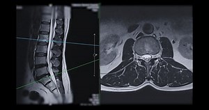 Mri L-s Spine Lumbar Spine Axial Stock Footage Video (100% Royalty-free) 1083251227 | Shutterstock