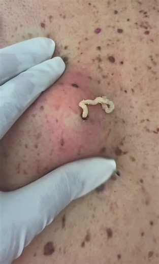 #extractions #xyzcba #cystremoval #creatorsearchinsights #satisfying | cyst
