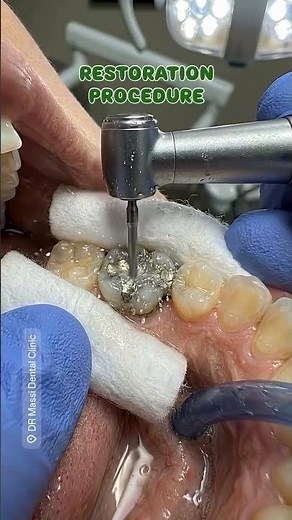 RESTORATION PROCEDURE