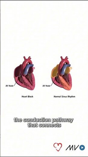 Heart block aka AV block