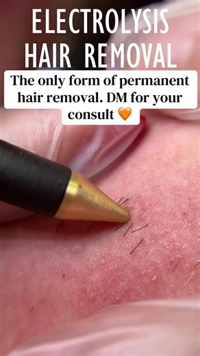 Understanding Electrolysis for Permanent Hair Removal