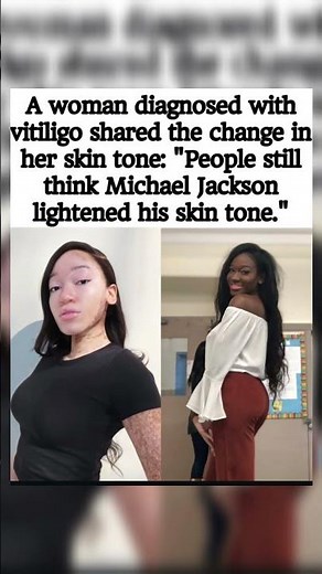 A woman with vitiligo shares her skin change journey #shortfeed #michaeljackson #viral