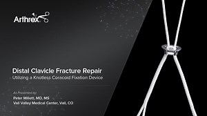 Distal Clavicle Fracture Repair - Utilizing a Knotless Coracoid Fixation Device