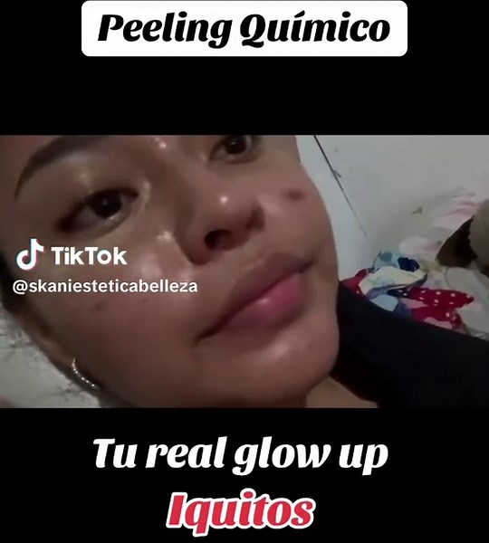 Somos tu mejor opción en la ciudad de Iquitos! Resultados reales. Atenía manchas de acné, cloasma, melasma, acné. Agenda tu cita al 989507608 #iquitos_peru🌴🌴♥️♥️♥️♥️ #iquitos_peru