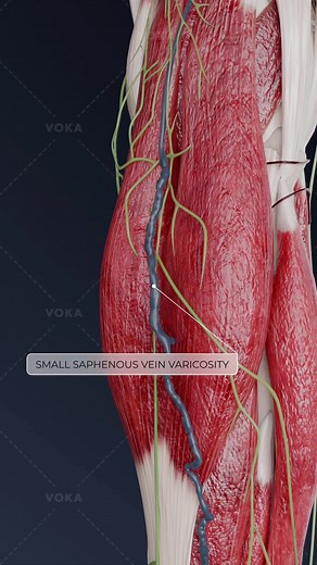 Varicosity of Superficial Veins: Impacts on Health