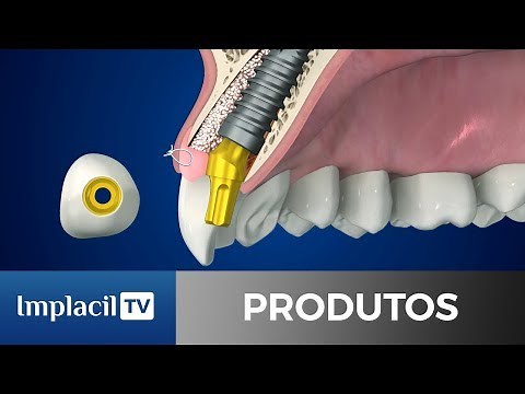 LANÇAMENTO LINHA IDEALE | IMPLACIL DE BORTOLI