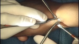 Dequervain's First Extensor Compartment Release