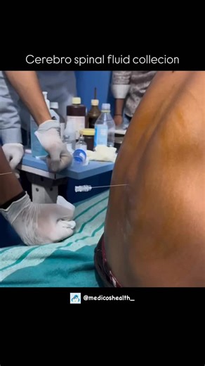 Medical & Health ⚕️ on Instagram: "Cerebrospinal Fluid (CSF) collection — a vital procedure done through a lumbar puncture to analyze brain and spinal health. This clear fluid gives doctors key insights into infections, bleeding, and neurological disorders. 💉✨ . . . . #viral #explore #medical #reel #education #doctor #medicalstudent #student #biology #study #science #knowledge #mbbsstudent #mbbs #medicalfacts #knowledge #didyouknow #medicalquestions #intrestingfacts #nurse #learning #hospital #