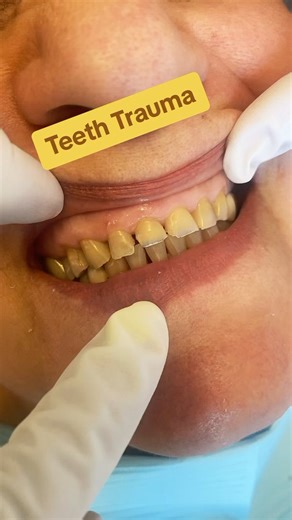 Grinding teeth away for years!!! Sensitive teeth? Grinding? #prevent #dental #smile #teeth | Le Chic Dentist