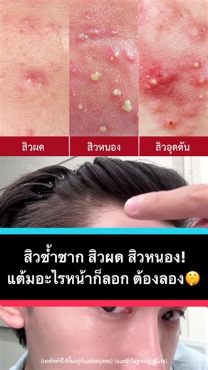 แต้มสิวยอดนิยม: เจลแต้มสิวแก้สิวซ้ำซาก สิวผด สิวหนอง
