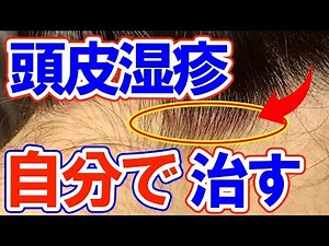 【驚愕】頭皮湿疹4つの種類と自宅でできる対処法！かゆみ赤みの原因と対策！