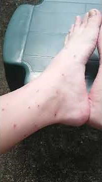 Chigger Cure NO BS
