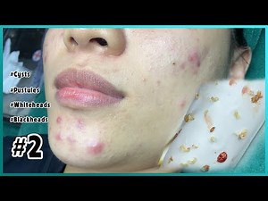 Big Cystic Acne Blackheads Extraction Blackheads & Milia, Whiteheads Removal Pimple Popping