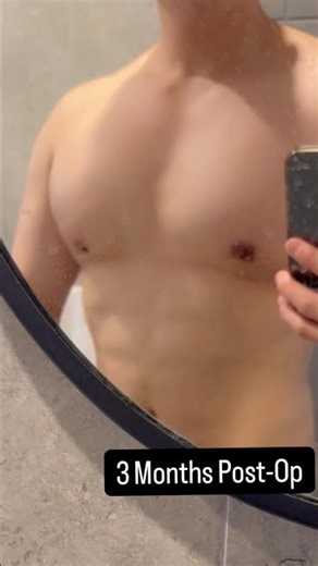 Pre-Op/1 Month Post-Op/3 Month Post-Op - Amazing Results #bodytransformation #gynecomastiaresult