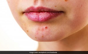 skin care : पिंपल्स दूर करने के लिए आजमाएं ये घरेलू उपाय, रात भर में दूर हो जाएगी समस्या और खिल उठेगा चेहरा!
