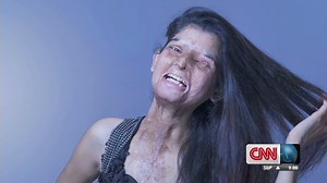 India acid attack victims face cameras