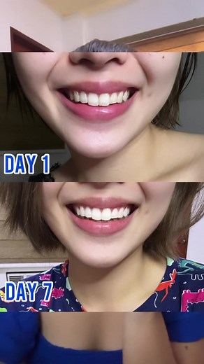 Whiten Your Teeth Fast with Sparkle White PH | Oral Beauty Tips