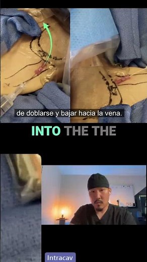 Ultrasound IV Guide: Perfect Catheter Advancement Technique! #shorts