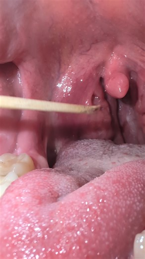 Tonsil Stones on Instagram: "Hi there 👋 struggle with oral hygiene complications? Try the first comment or dm me with any questions! . . . . . . . . . . #tonsilstones #tonsiliths #mouth #asmr"