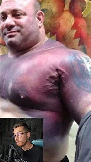 Powerlifter Brutally Injures His Chest Muscle | This Is How His Body Looked 🫣