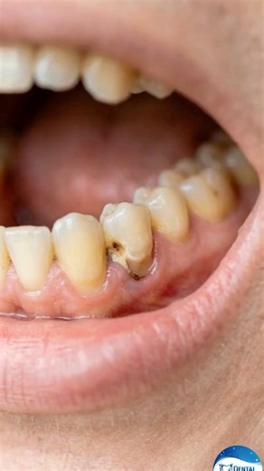 Gum Line Tooth Repair : A Cinematic Step-by-Step Restoration #toothrepair #restoration