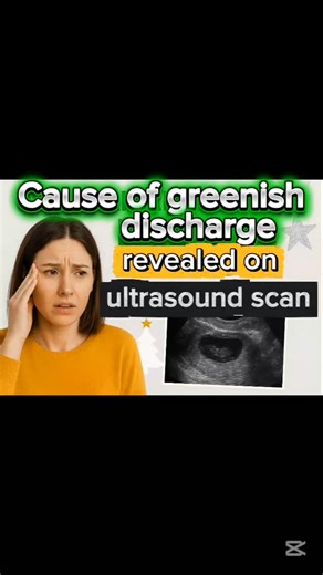 Cause of post-cs discharge revealed on ultrasound scan. | Captain medix TV
