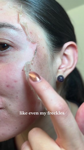 Chemical Peel Journey: Glowing Results and Acne Treatment