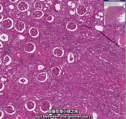 | 肾病理切片 | 急性和慢性肾盂肾炎 | Histopathology Kidney-- Acute and chronic pyelonephritis